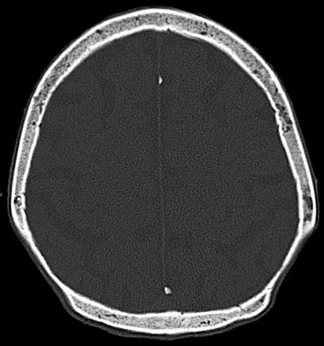Bilateral parietal kemik incelmesi: yayımlanmış olgu görüntüsü, koronal+aksiyel kesit