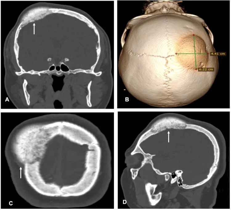 İntraosseöz meningiom: yayımlanmış olgu görüntüsü, koronal, aksiyel, sagittal ve 3B kesit