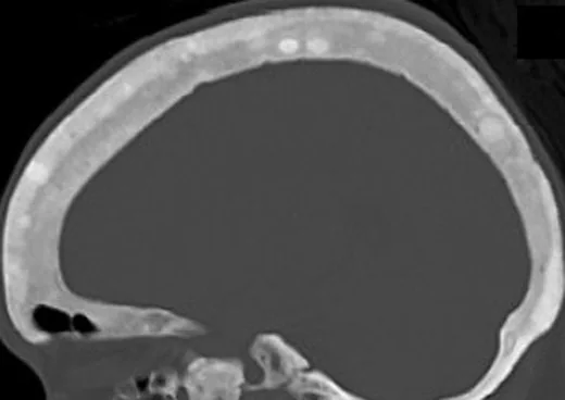 Metabolik kemik hastalığının kafatası bulguları: yayımlanmış olgu görüntüsü, sagittal kesit