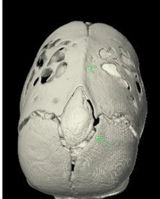 Sagittal sütür sinostozu: yayımlanmış olgu görüntüsü, 3B kesit