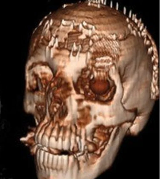 Postoperatif kalvaryal değişiklik ve kemik flebi: yayımlanmış olgu görüntüsü, aksiyel+koronal+sagittal+3B kesit