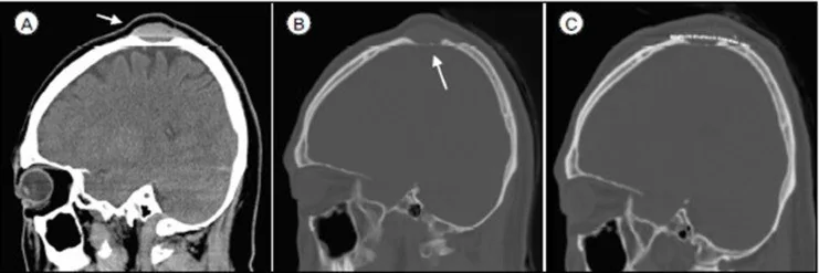 Sinus pericranii: yayımlanmış olgu görüntüsü, sagittal kesit