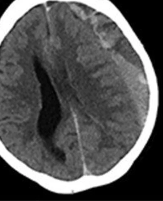 Kronik subdural hematom: yayımlanmış olgu görüntüsü, aksiyel kesit
