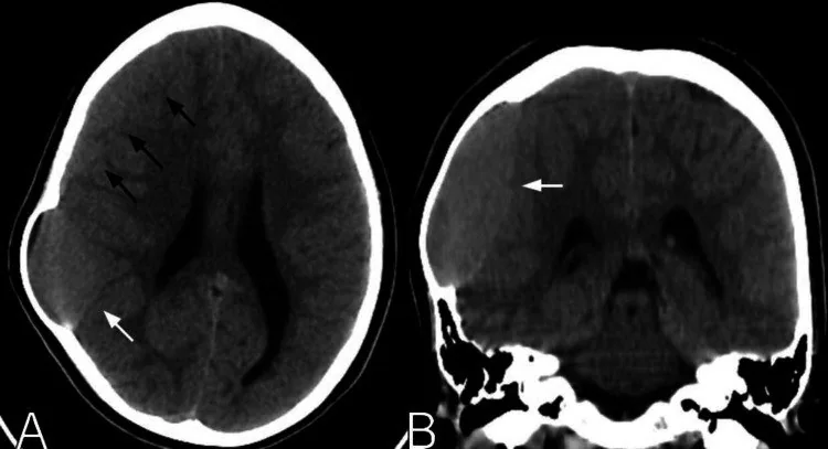 İzodens/subakut subdural hematom: yayımlanmış olgu görüntüsü, aksiyel kesit