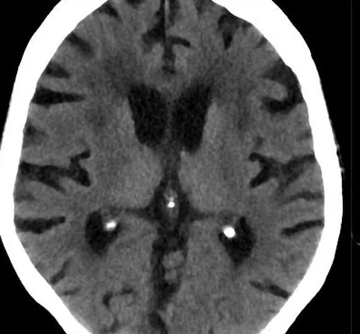 Fizyolojik intrakraniyal kalsifikasyonlar: yayımlanmış olgu görüntüsü, aksiyel|koronal|sagittal kesit