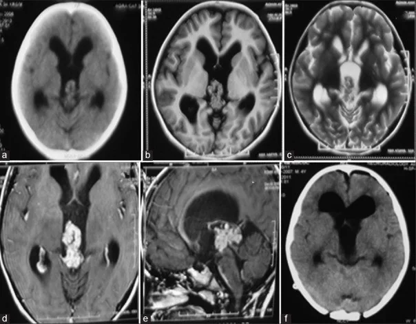 Koroid pleksus tümörü: yayımlanmış olgu görüntüsü, aksiyel kesit
