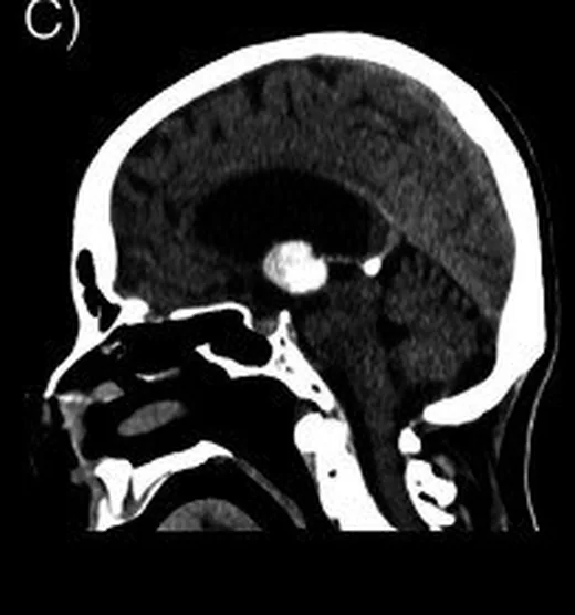Kitleye bağlı obstrüktif hidrosefali: yayımlanmış olgu görüntüsü, aksiyel+koronal+sagittal kesit
