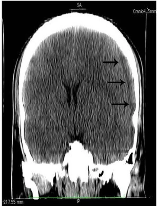 Subdural veya epidural ampiyem: yayımlanmış olgu görüntüsü, aksiyel kesit
