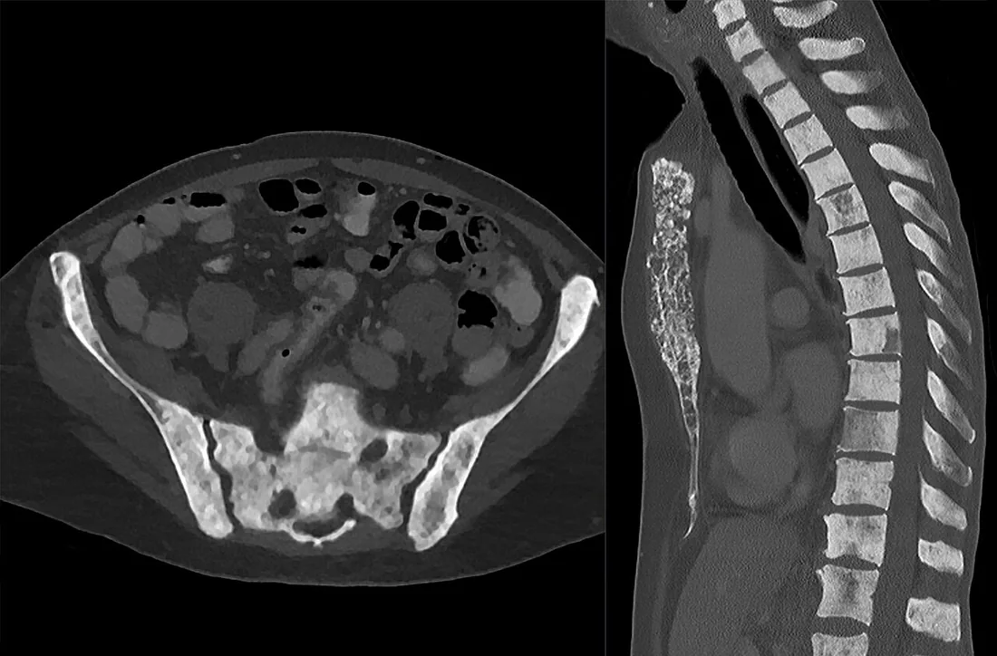Litik, sklerotik ve mikst kemik metastazları: yayımlanmış olgu görüntüsü, aksiyel kesit