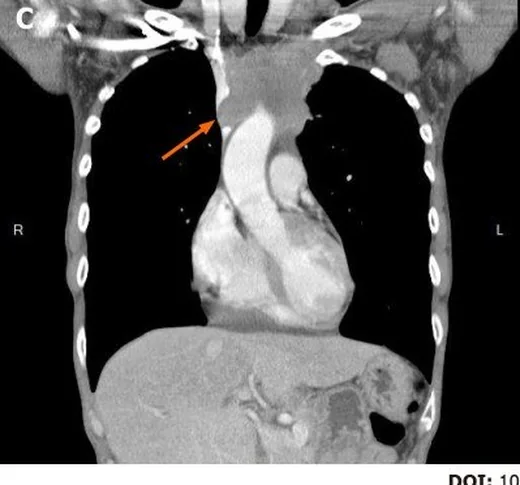 Mediastinal tümör ve damar invazyonu: yayımlanmış olgu görüntüsü, aksiyel kesit