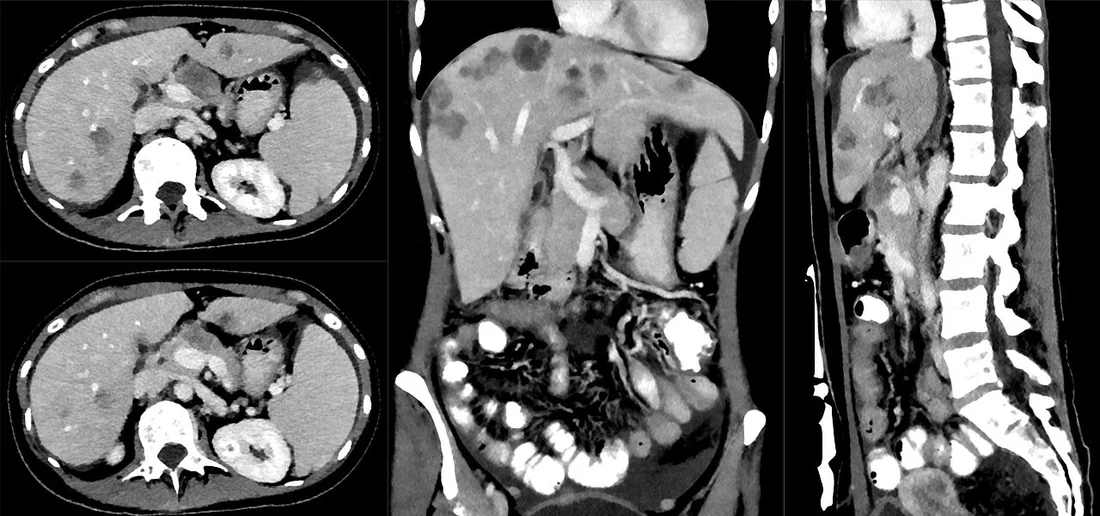 Pankreas metastazları: yayımlanmış olgu görüntüsü, 3B kesit