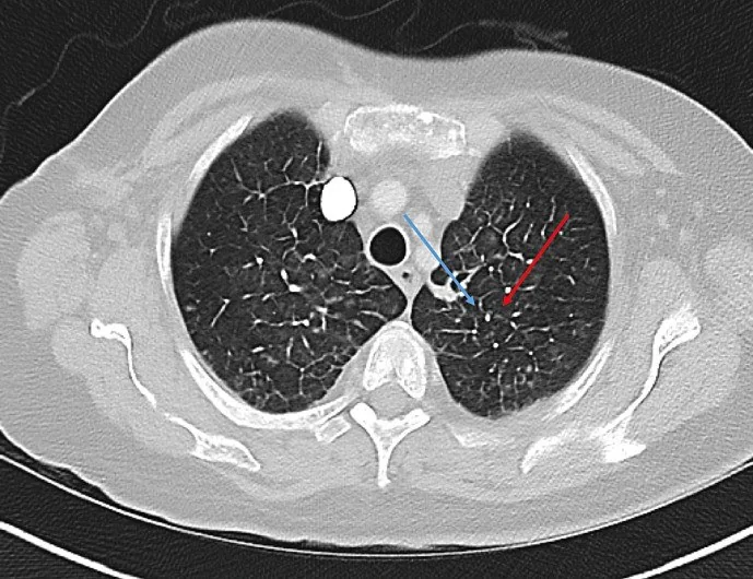 Pulmoner tümör embolisi ve tümör mikroanjiyopatisi: yayımlanmış olgu görüntüsü, aksiyel kesit