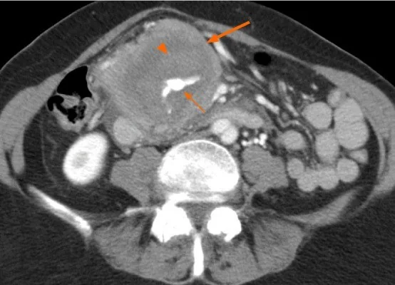 Tümör ilişkili intraabdominal kanama: yayımlanmış olgu görüntüsü, aksiyel kesit