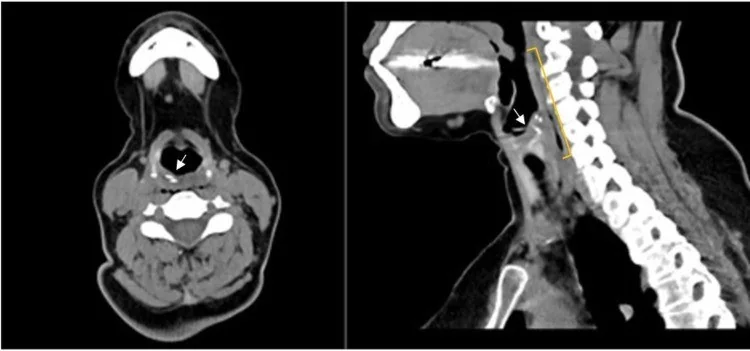 Üst hava yolunda yabancı cisim: yayımlanmış olgu görüntüsü, sagittal kesit