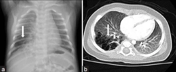 Konjenital pulmoner hava yolu malformasyonu (CPAM): yayımlanmış olgu görüntüsü, aksiyel kesit