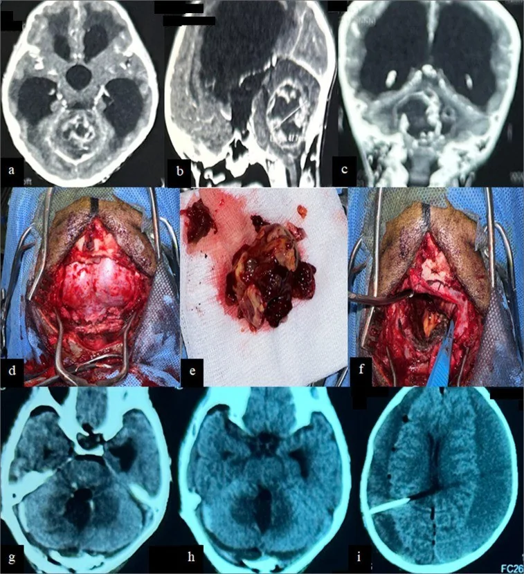 Posterior fossa tümörleri: medulloblastom, ependimom ve pilositik astrositom: yayımlanmış olgu görüntüsü, aksiyel kesit
