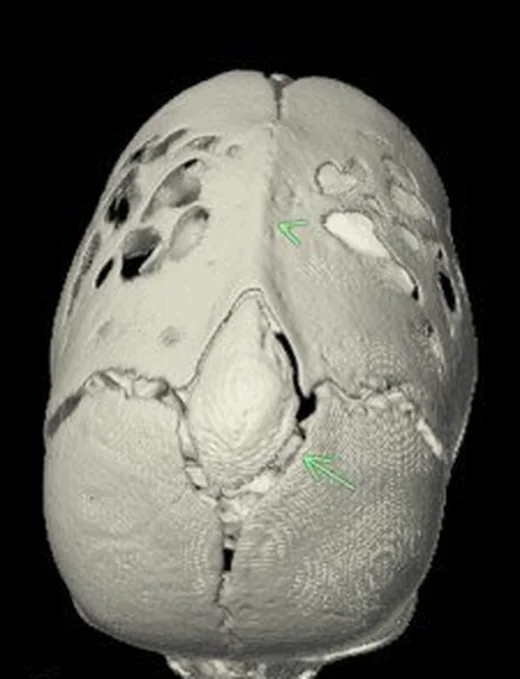 Sagittal sütür sinostozu: yayımlanmış olgu görüntüsü, 3B kesit