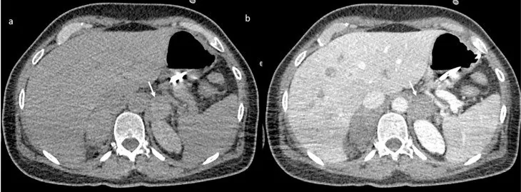 Çocukta adrenal kanama: yayımlanmış olgu görüntüsü, aksiyel kesit