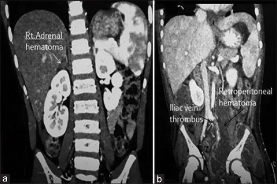 Çocukta adrenal travması: yayımlanmış olgu görüntüsü, koronal kesit