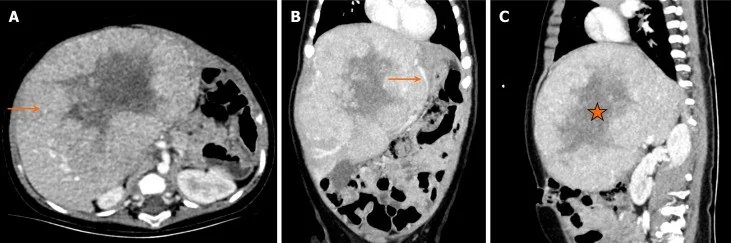 Hepatoblastom: yayımlanmış olgu görüntüsü, aksiyel kesit