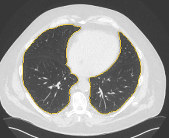 Bölge anatomisi, BT kesiti: Akciğer sınırı sarı çizgiyle işaretli
