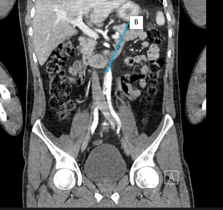 Abdominal aorta ve visseral damar yaralanması: yayımlanmış olgu görüntüsü, koronal kesit