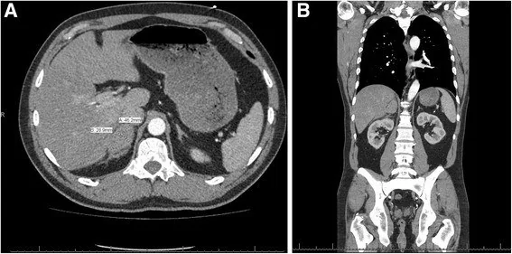Adrenal travma ve hematom: yayımlanmış olgu görüntüsü, aksiyel kesit