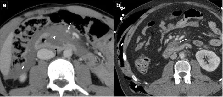 Duodenal ve retroperitoneal yaralanma: yayımlanmış olgu görüntüsü, aksiyel kesit