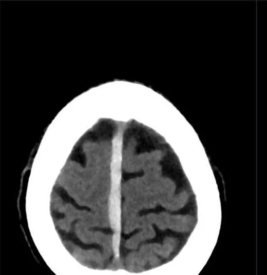 Subdural hematom: yayımlanmış olgu görüntüsü, aksiyel kesit